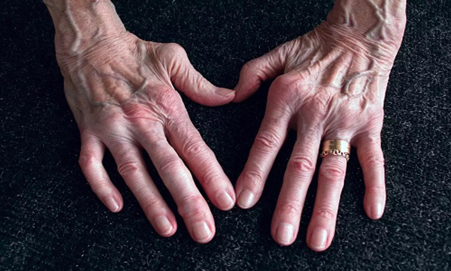 What is Rheumatoid Arthritis? Know symptoms and Causes...