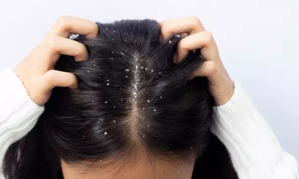 Get rid of dandruff with home remedies