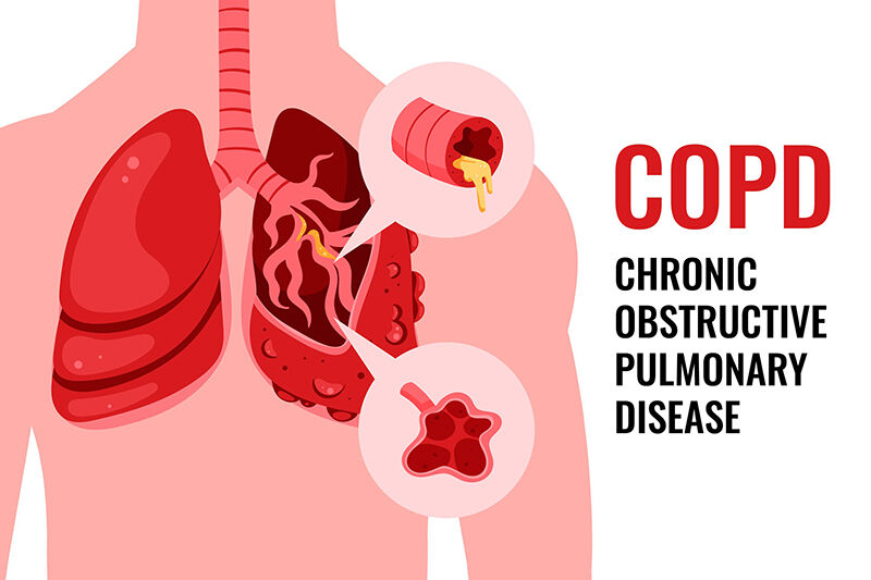 Copd Third Leading Cause Of Death In World; Know How To Keep Your Lungs 