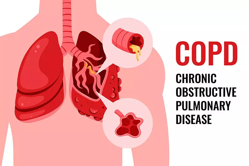 COPD third leading cause of death in world; Know how to keep your lungs healthy