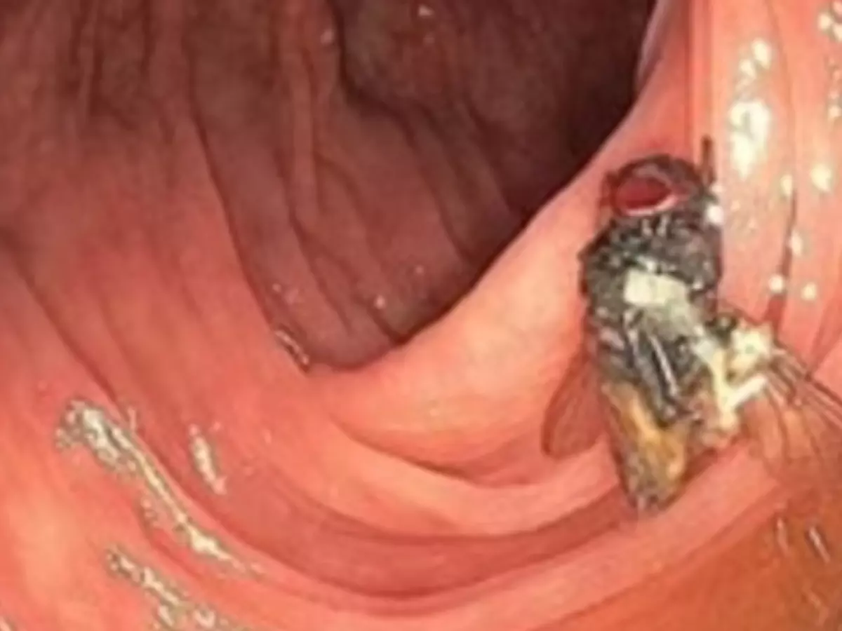 Live fly found in old mans intestine! How it entered the body, even doctors are surprised