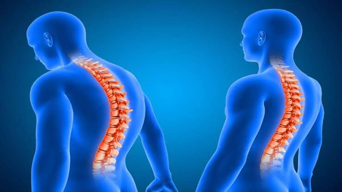 What is a slipped disc? Know everything in detail