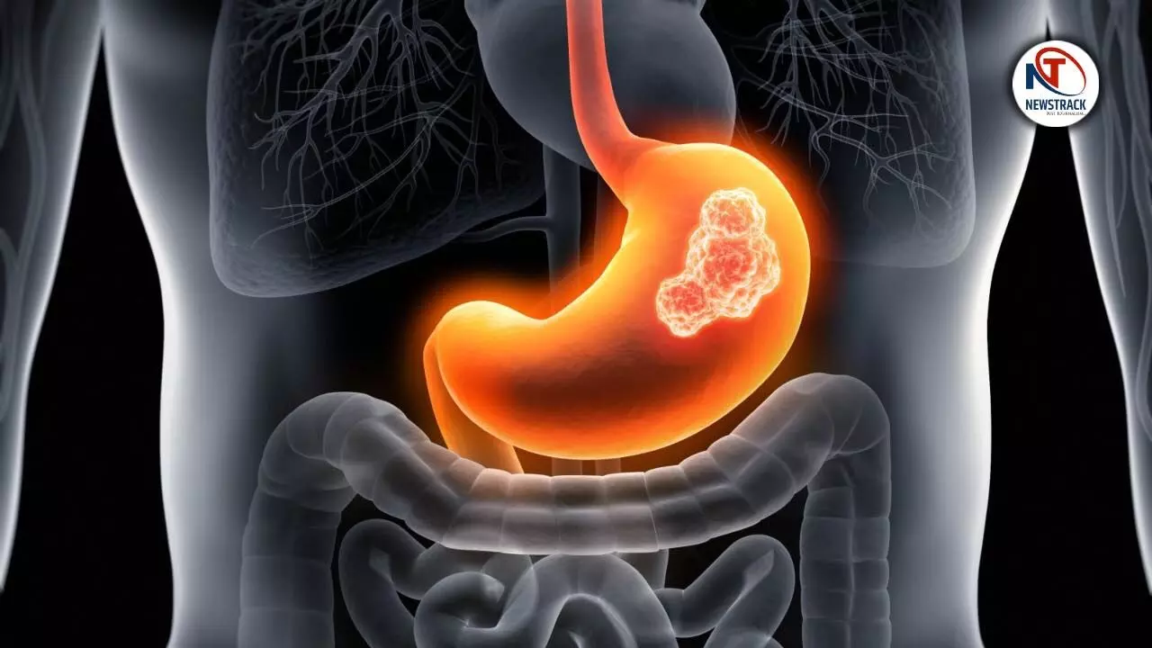 Risk of Gastric Cancer Sign Causes and Treatment