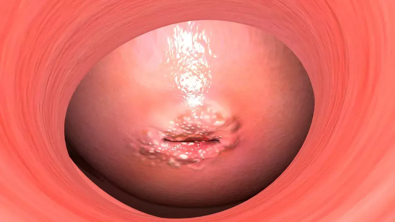 cervical cancer cervical cancer