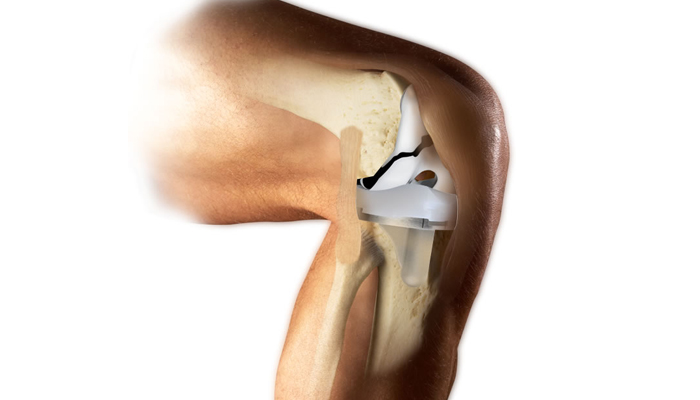 Huge relief for knee implant patients as regulator caps