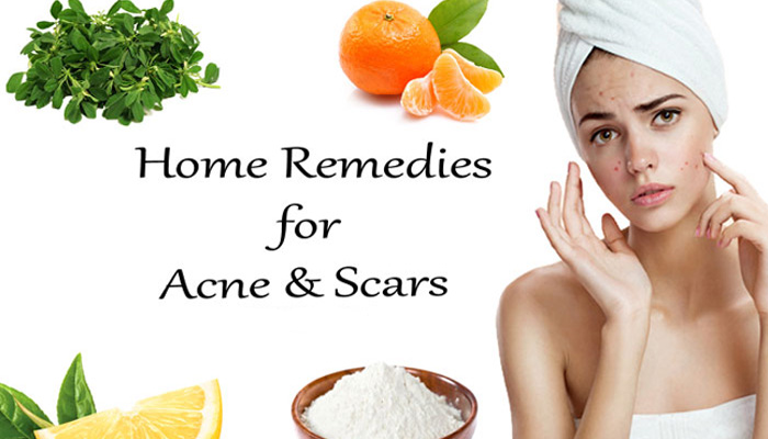 Pimples? Dont worry here are 8 simple ways to get rid of them naturally