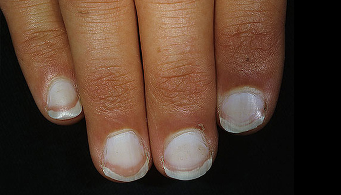 know-more-about-nail-abnormalities-symptoms-causes-and-effects