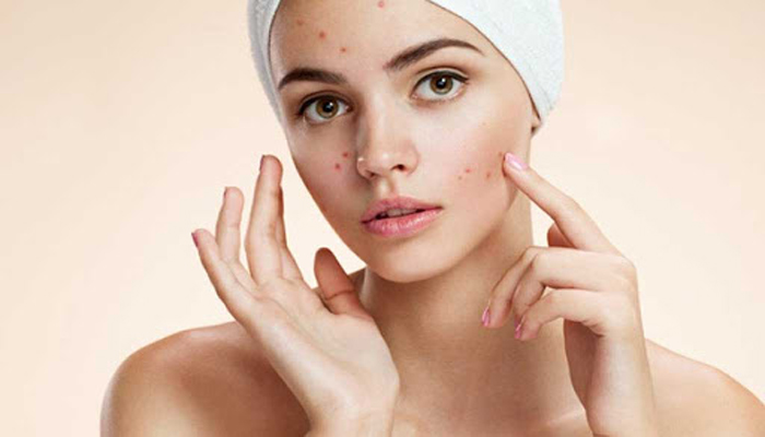 Heal Acne-Prone Skin with this Face Pack