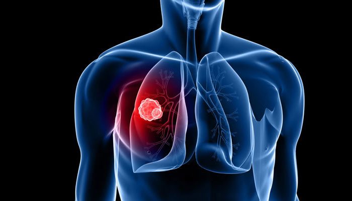 Anti-inflammatory drug may reduce risk of lung cancer