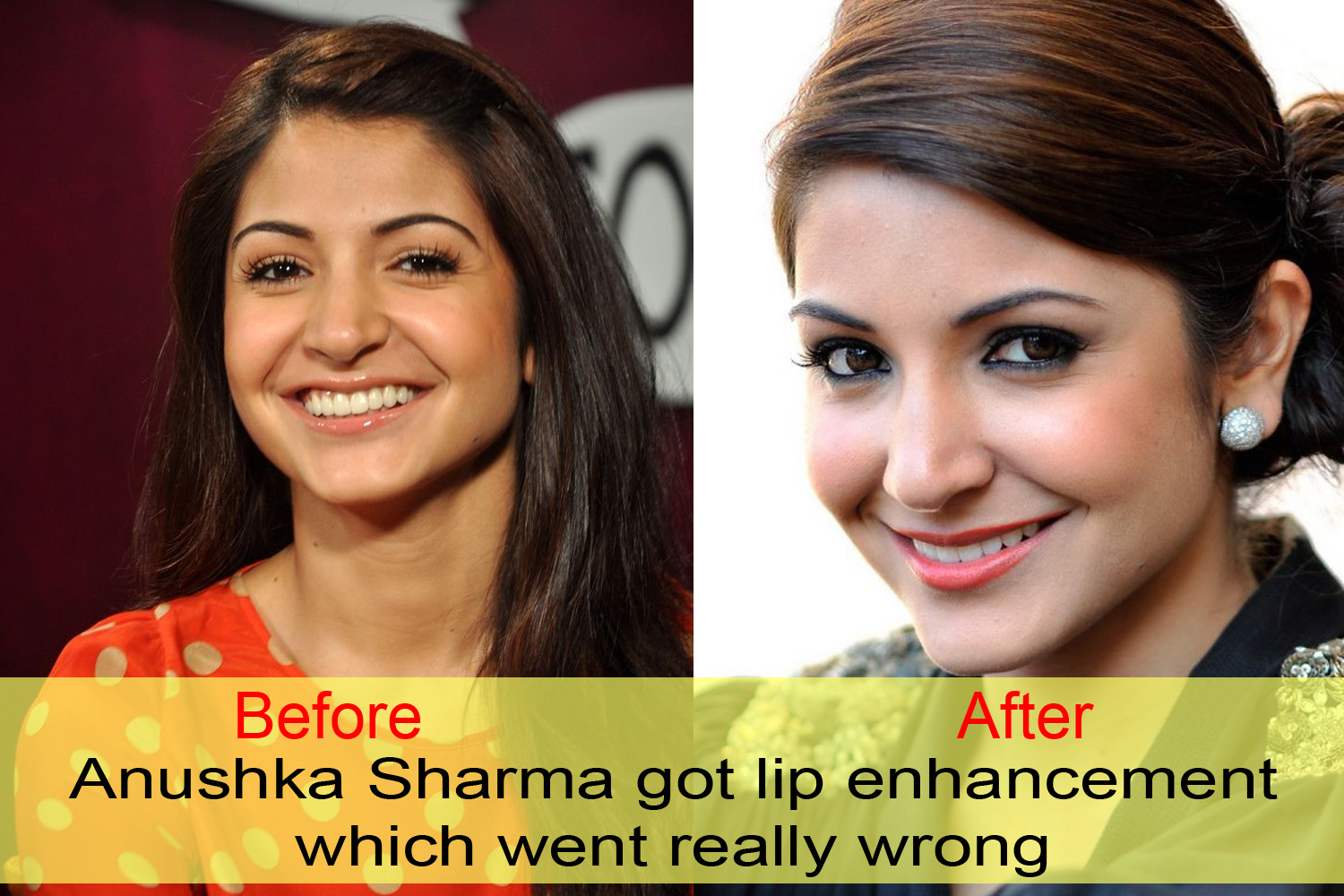 10 Bollywood Celebrities Before And After Plastic Surgery