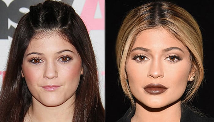 Kylie Jenner gets lip fillers again